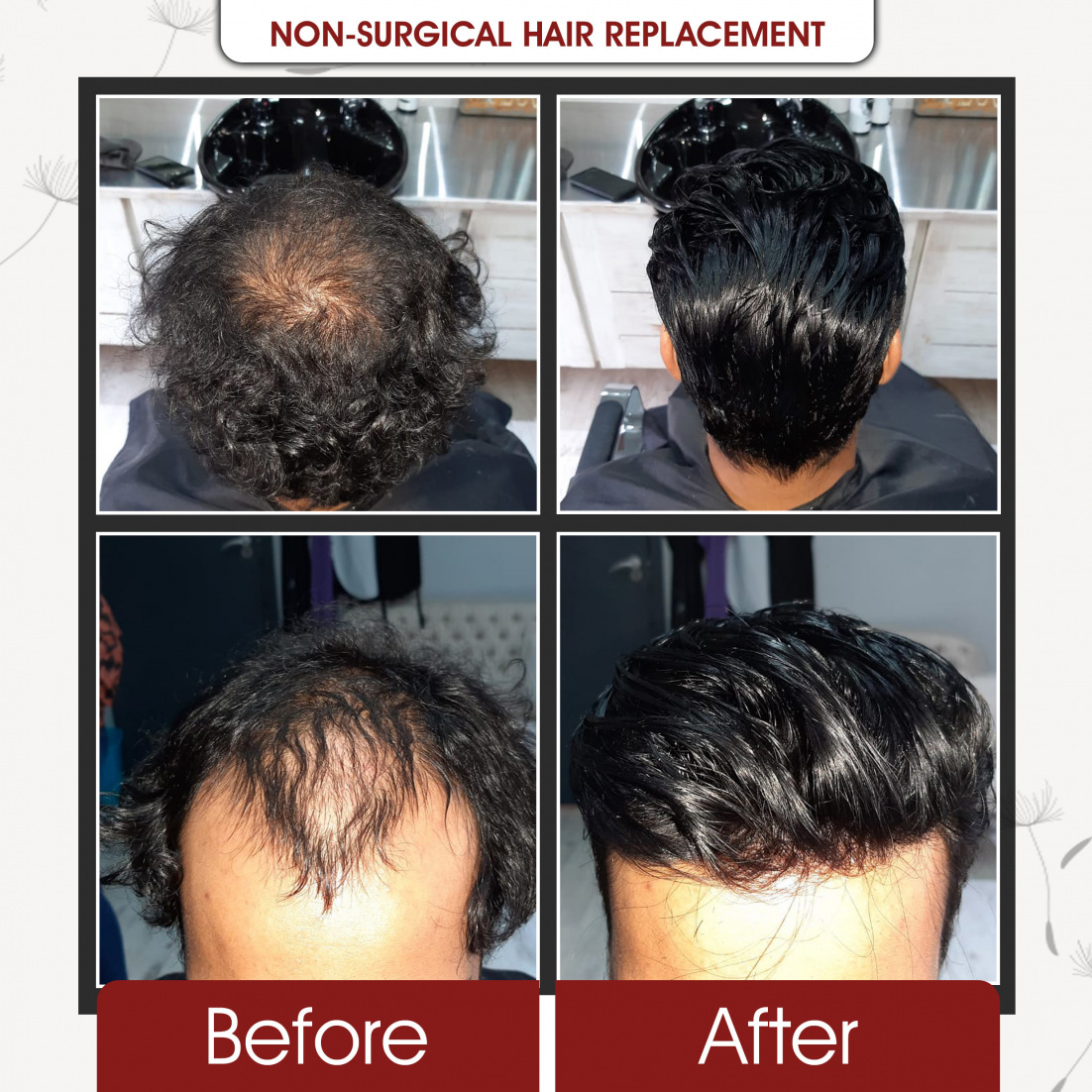 Non Surgical Hair Replcement