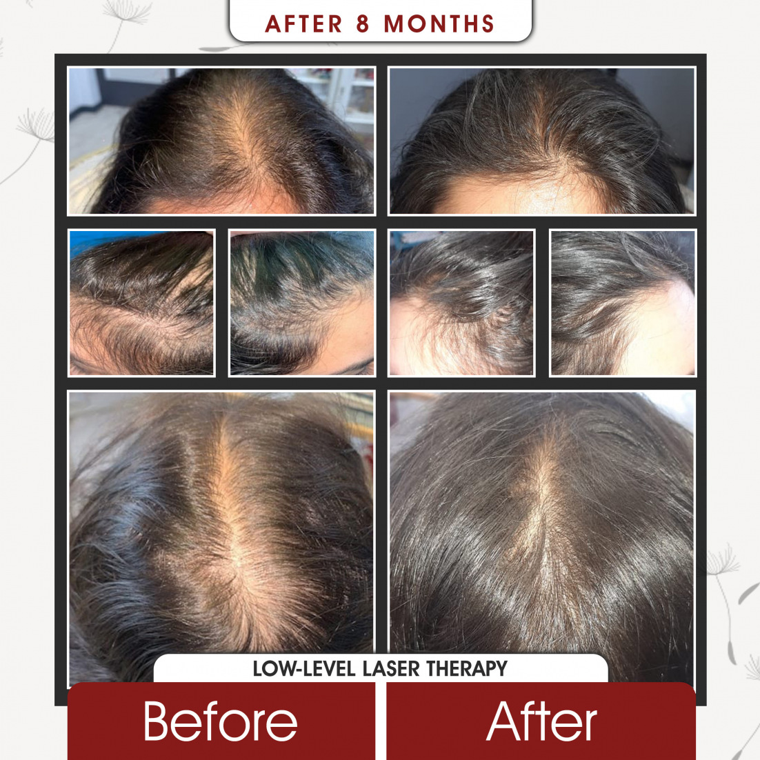 Low Level Laser Therapy After 8 Months