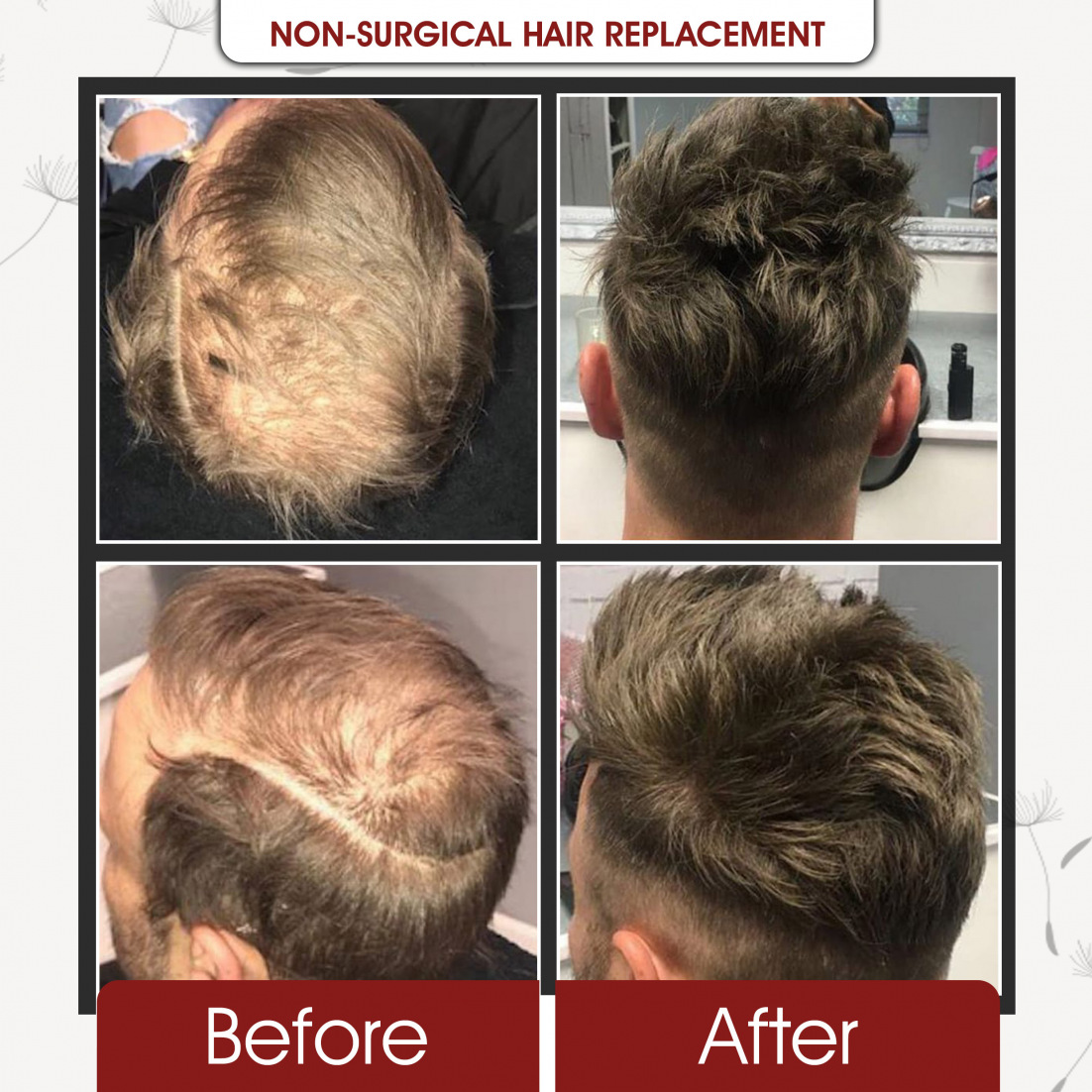 Non Surgical Hair Replcement