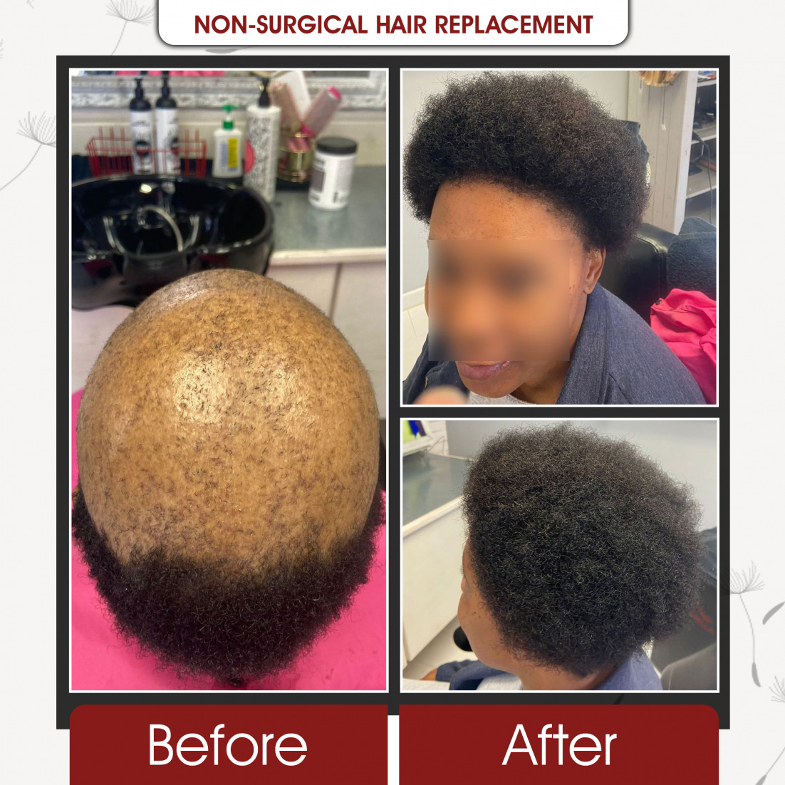 Non Surgical Hair Replcement