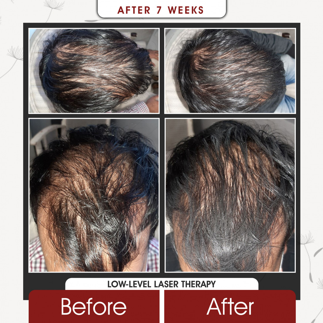 Low Level Laser Therapy After 7 Weeks