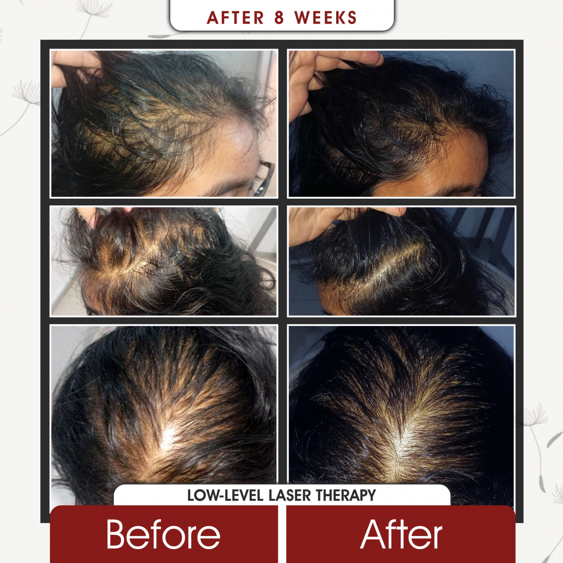 Low Level Laser Therapy After 8 Weeks